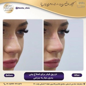 تزریق-ژل28