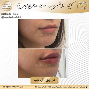 تزریق-ژل29