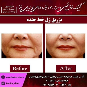 تزریق-ژل3
