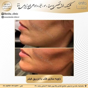 تزریق-ژل30