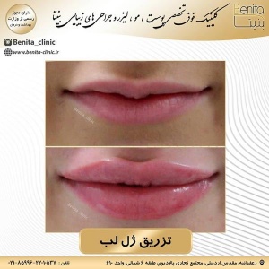 تزریق-ژل31