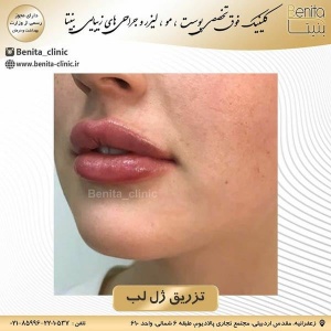 تزریق-ژل32