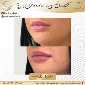 تزریق-ژل33