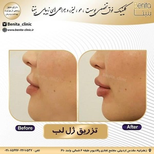 تزریق-ژل34