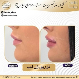 تزریق-ژل35