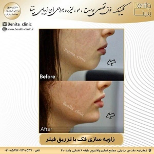 تزریق-ژل36