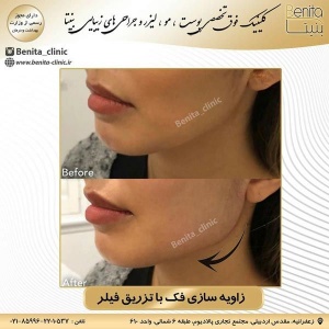 تزریق-ژل37