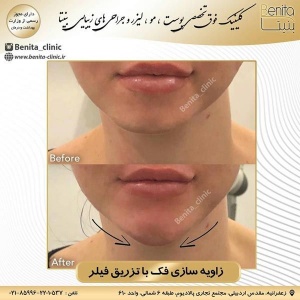 تزریق-ژل38