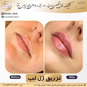 تزریق-ژل39