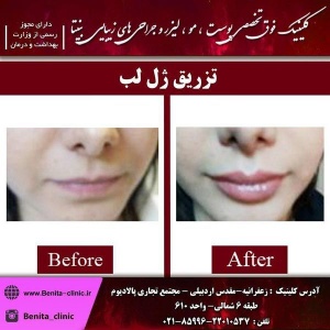 تزریق-ژل4