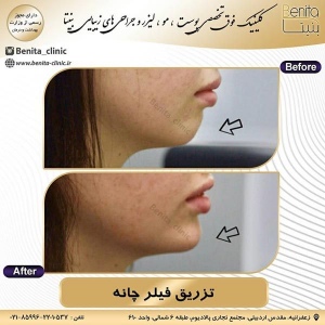 تزریق-ژل40