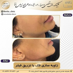 تزریق-ژل41