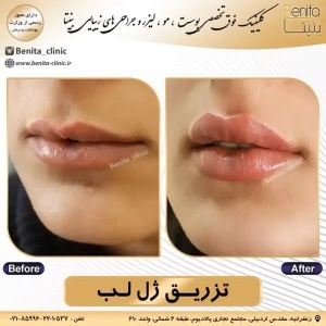 تزریق-ژل42