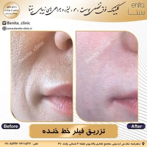 تزریق-ژل44