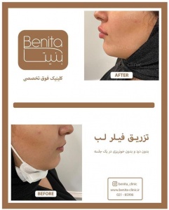 تزریق-ژل45