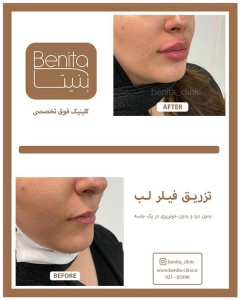 تزریق-ژل46