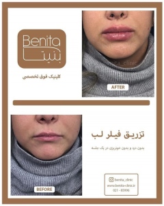 تزریق-ژل48