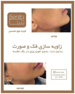 تزریق-ژل49
