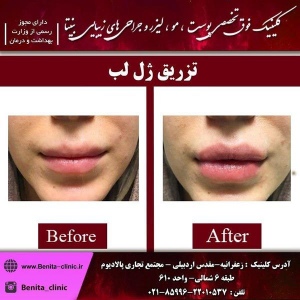 تزریق-ژل5