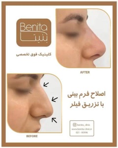 تزریق-ژل53