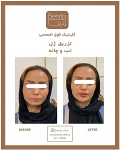 تزریق-ژل54