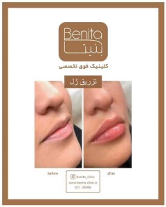 تزریق-ژل55