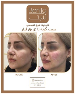 تزریق-ژل56
