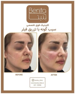 تزریق-ژل57