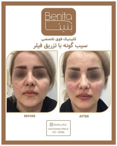 تزریق-ژل58