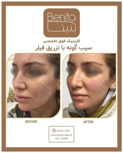 تزریق-ژل59