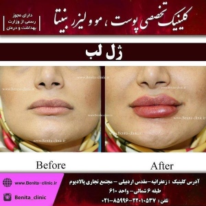 تزریق-ژل6