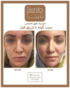 تزریق-ژل60