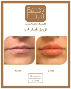 تزریق-ژل64