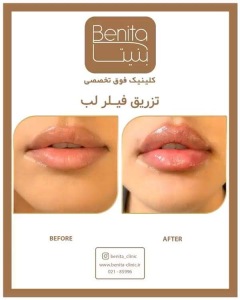 تزریق-ژل66