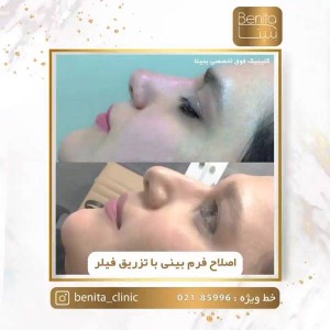 تزریق-ژل67