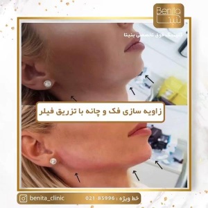 تزریق-ژل68