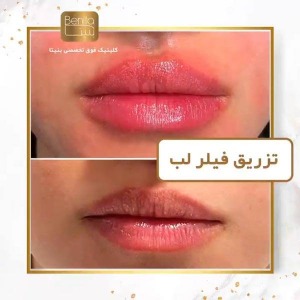 تزریق-ژل69