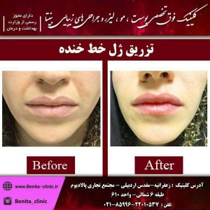 تزریق-ژل7