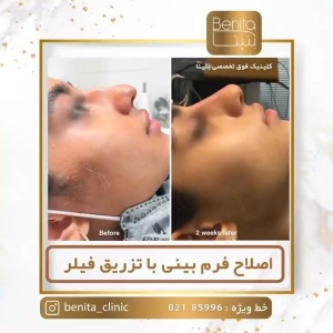 تزریق-ژل70