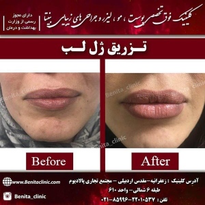 تزریق-ژل8