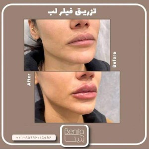 تزریق-ژل-90