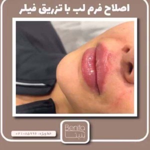 تزریق-ژل-87