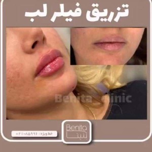 تزریق-ژل-89