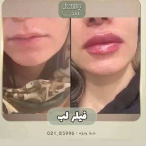 تزریق-ژل-86