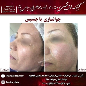 جوانسازی-1
