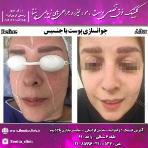 جوانسازی-3