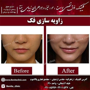 زاویه-سازی-صورت-1