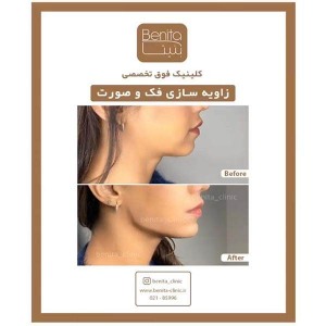 زاویه-سازی-صورت-2