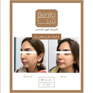 زاویه-سازی-صورت-3