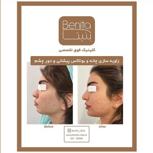 زاویه-سازی-صورت-5
